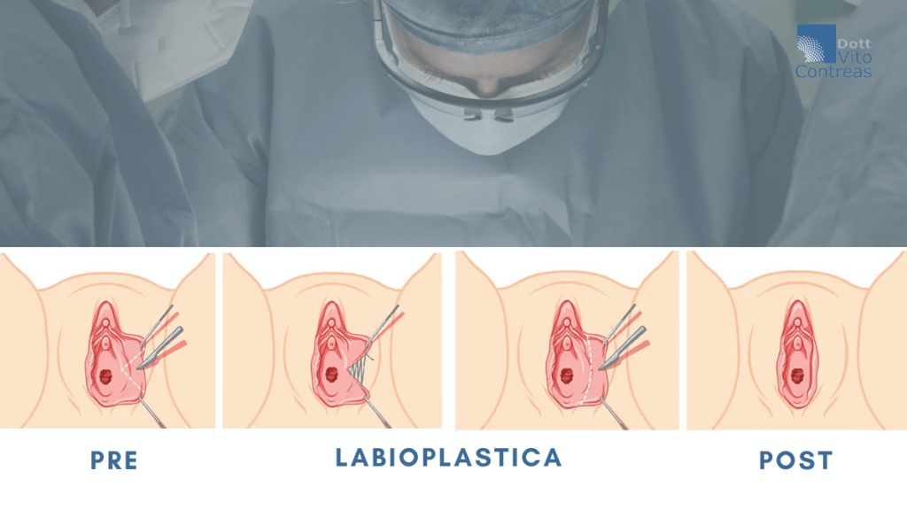 intervento labioplastica
